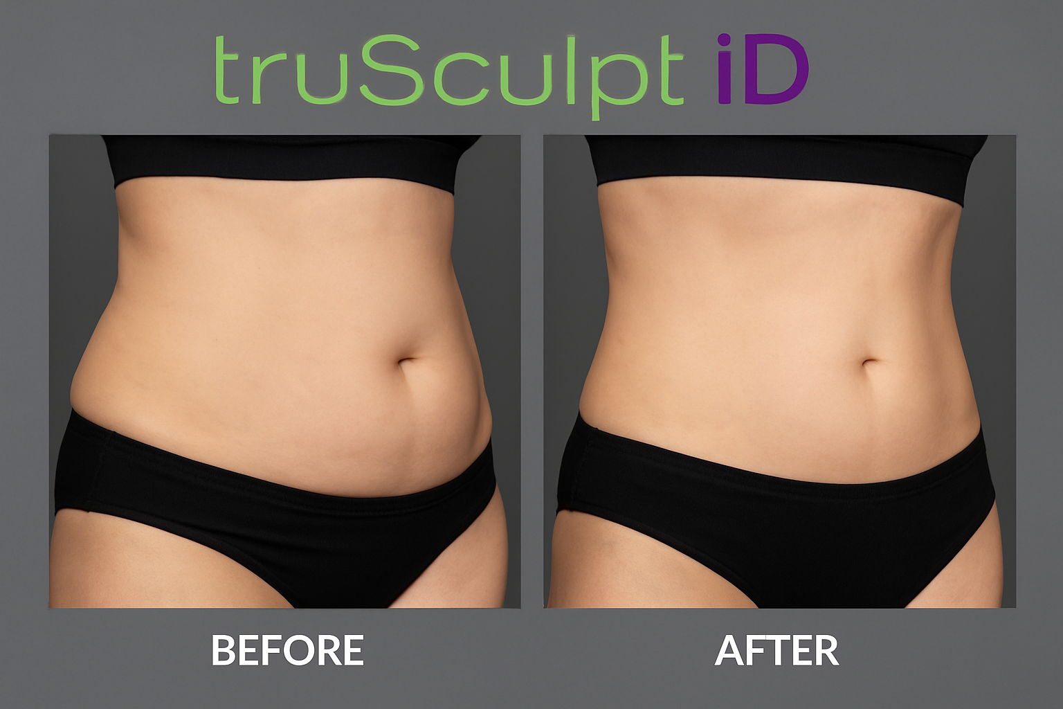 TruSculpt ID Review: Real Results from Body Contouring