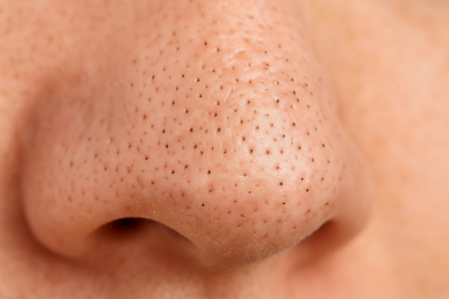Should You Pop Blackheads? Safe Removal Tips from Dermatologists