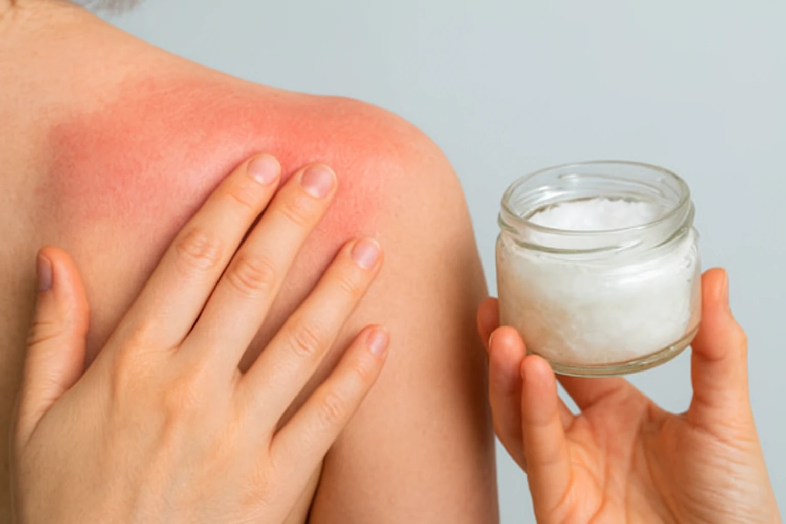 Can Coconut Oil Help Sunburn? Dermatologists Reveal Truth